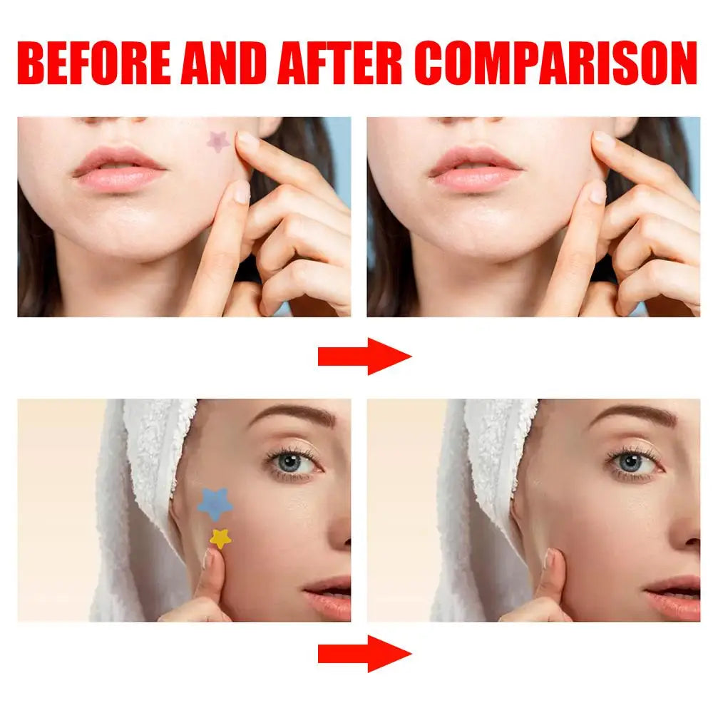 200 Patches Acnes Pimple Patches for Zits and Blemishes,Spots